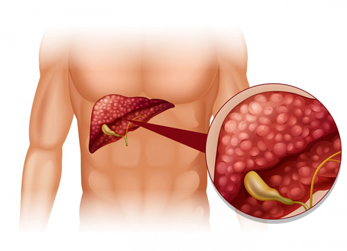 liver cancer