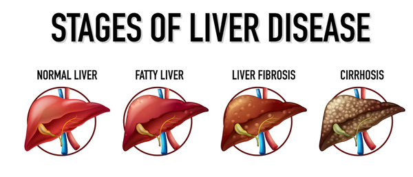 Liver Cirrhosis