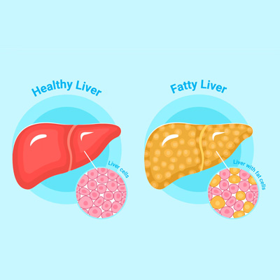 Non-Alcoholic Fatty Liver Disease