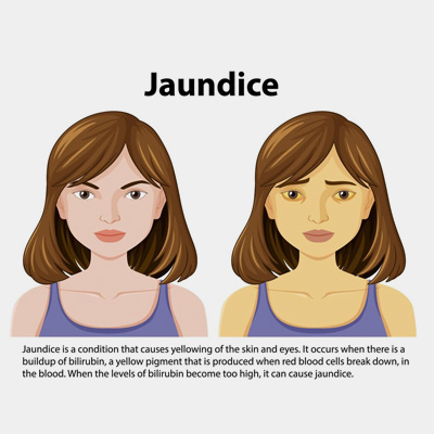 Jaundice