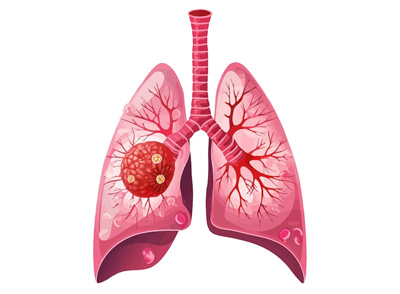 Lung Cancer