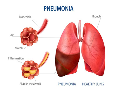 Lung Cancer