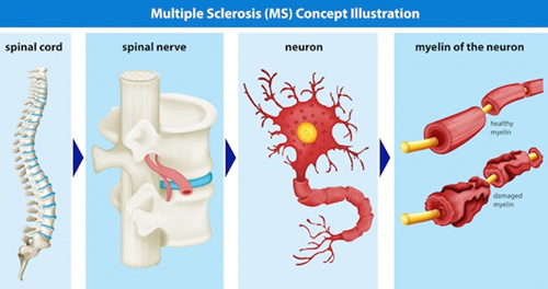 Multiple Sclerosis