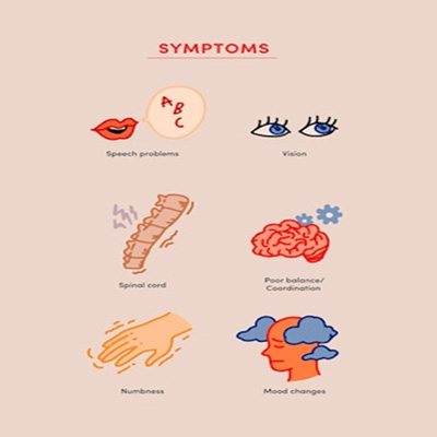 Multiple Sclerosis