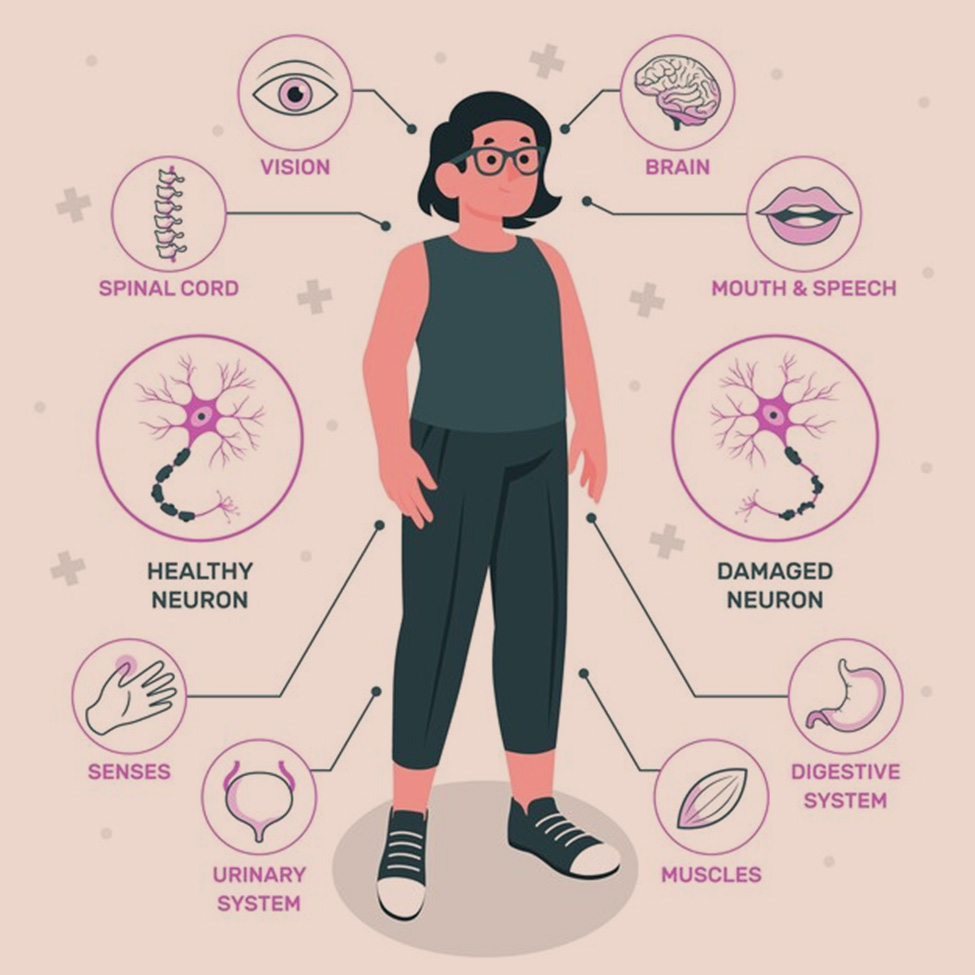 Multiple Sclerosis