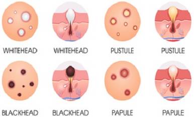 pimples types