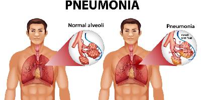 pneumonia