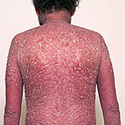 Erythrodermic psoriasis