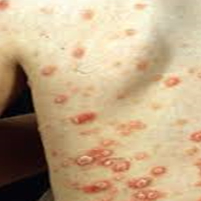 Guttate psoriasis