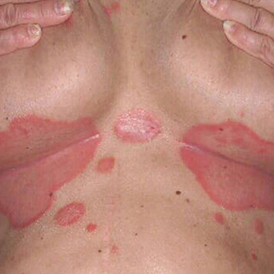 Inverse psoriasis