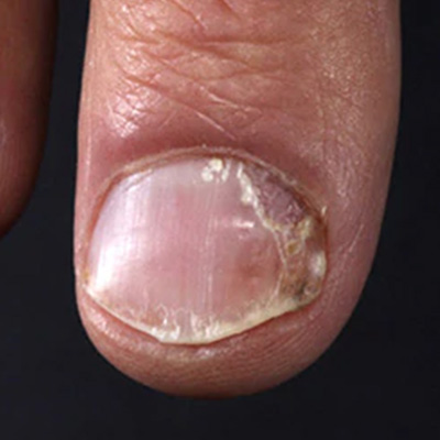 Nail psoriasis