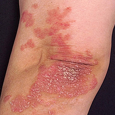 Plaque psoriasis