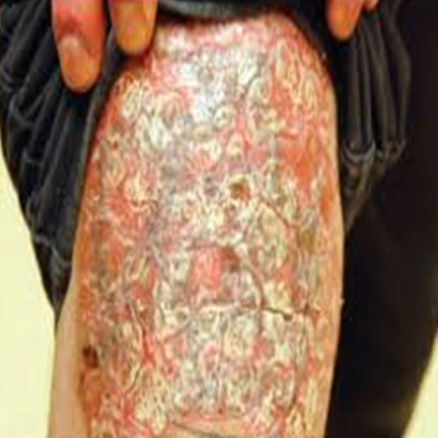 Plaque psoriasis