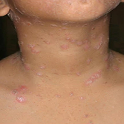 Plaque psoriasis