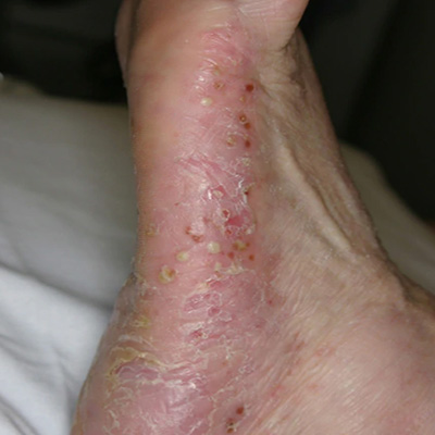 Pustular psoriasis