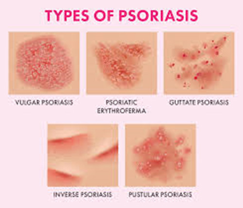 types of psoriasis