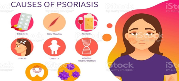 Causes of Psoriasis