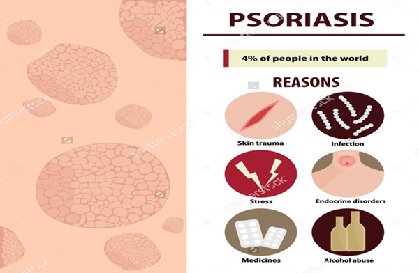 psoriasis triggers