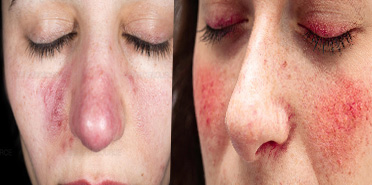 Rosacea