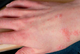 scabies symptom