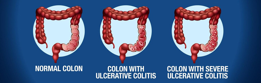 Ulcerative Colitis Management