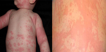 Hives Urticaria