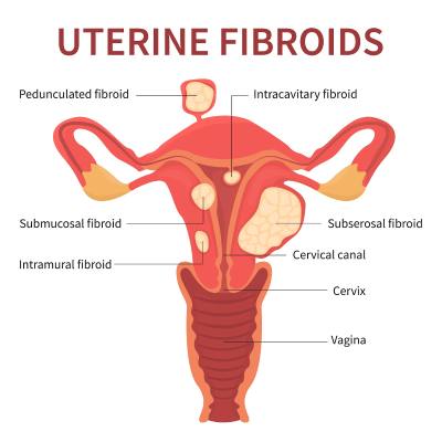 uterine fibroids