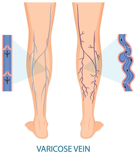 Varicose veins