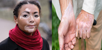 vitiligo