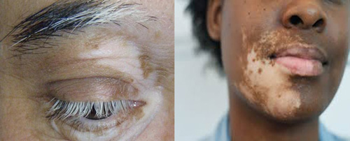 vitiligo symptom