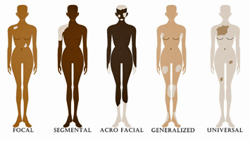 vitiligo Types